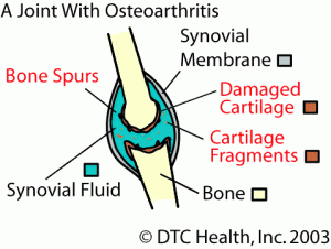 osteoarthritis joint